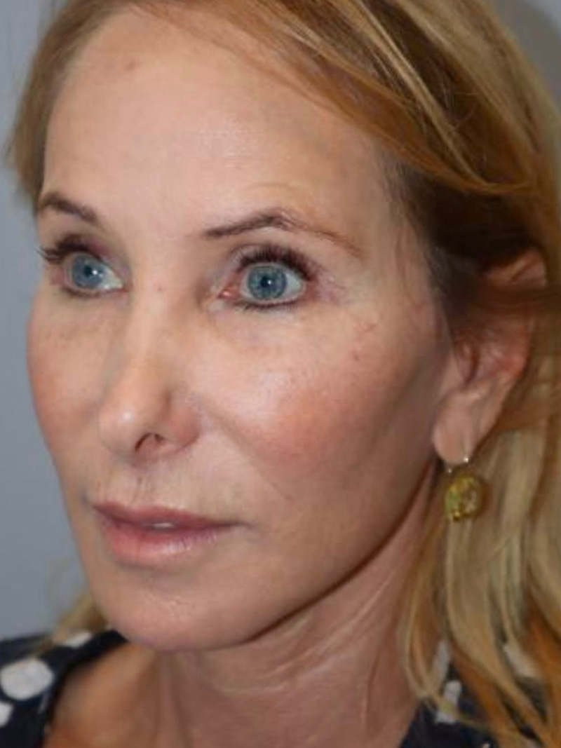 Facelift Before and After 47 | Grover Aesthetics