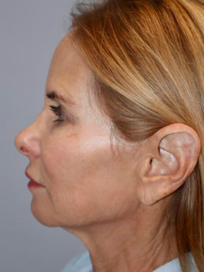 Facelift Before and After 47 | Grover Aesthetics