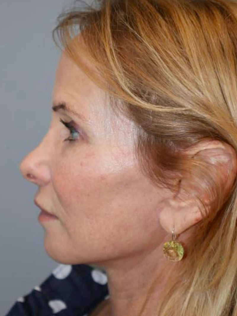 Facelift Before and After 47 | Grover Aesthetics