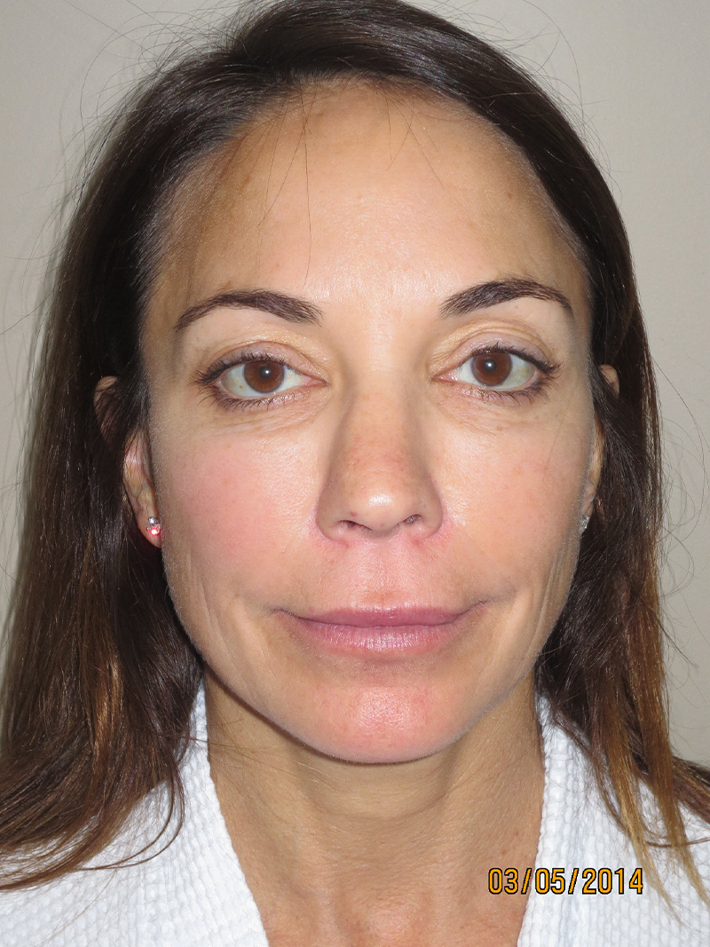 Facelift Before and After 22 | Grover Aesthetics