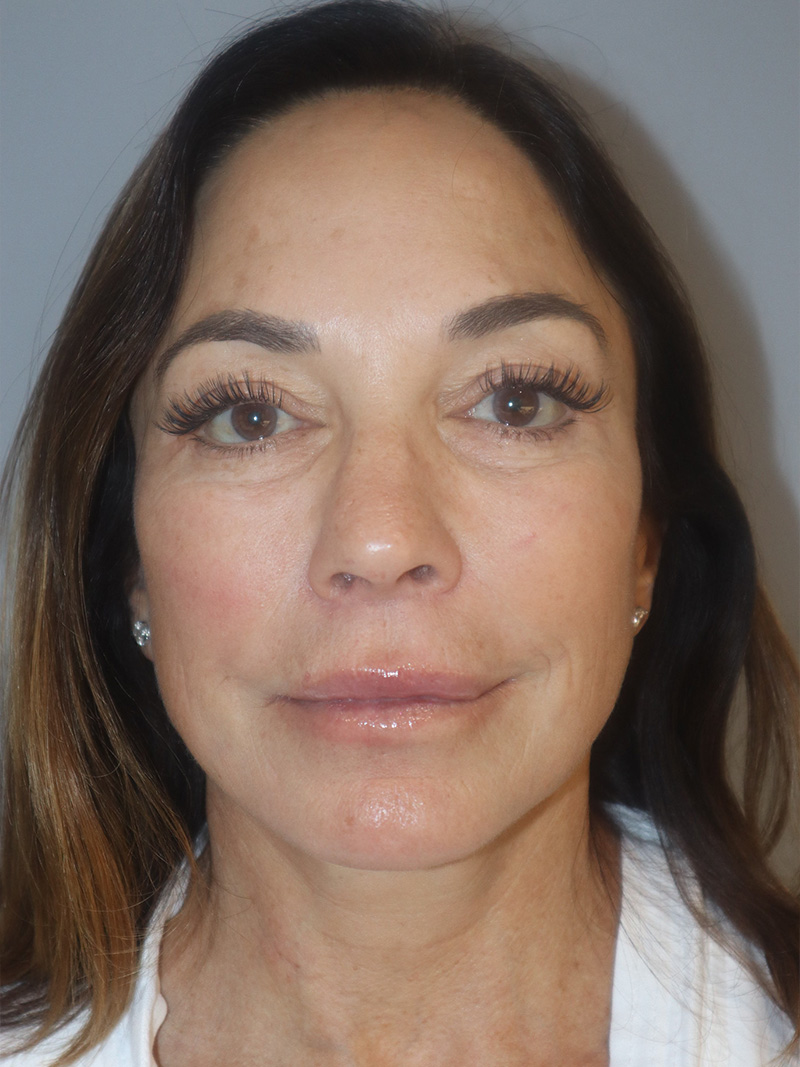 Facelift Before and After 48 | Grover Aesthetics