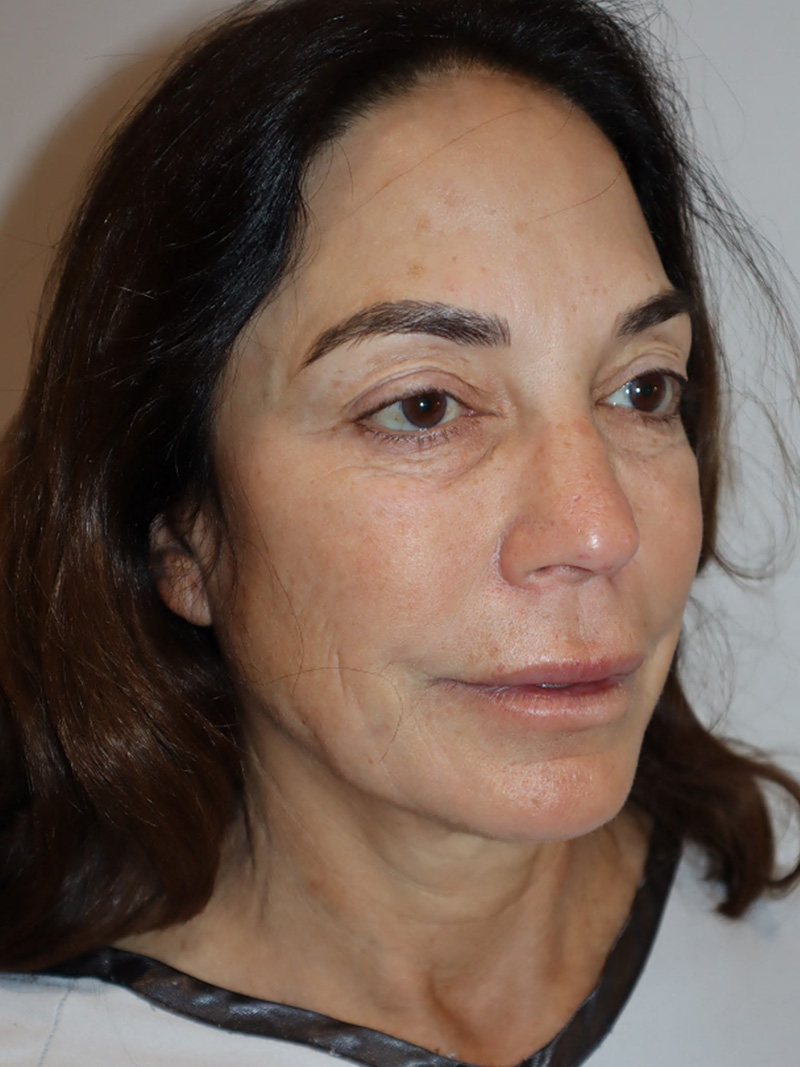 Facelift Before and After 48 | Grover Aesthetics