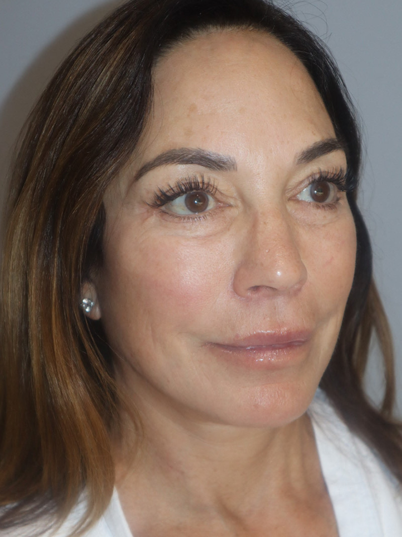 Facelift Before and After 48 | Grover Aesthetics