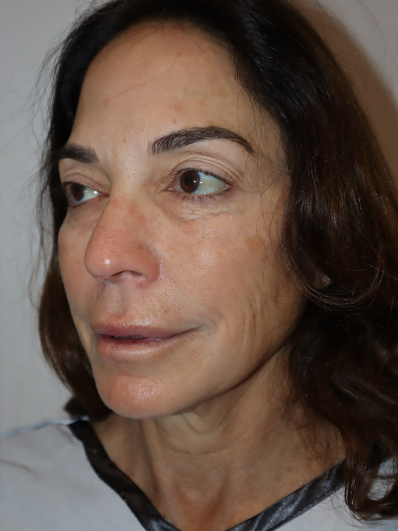 Facelift Before and After 48 | Grover Aesthetics