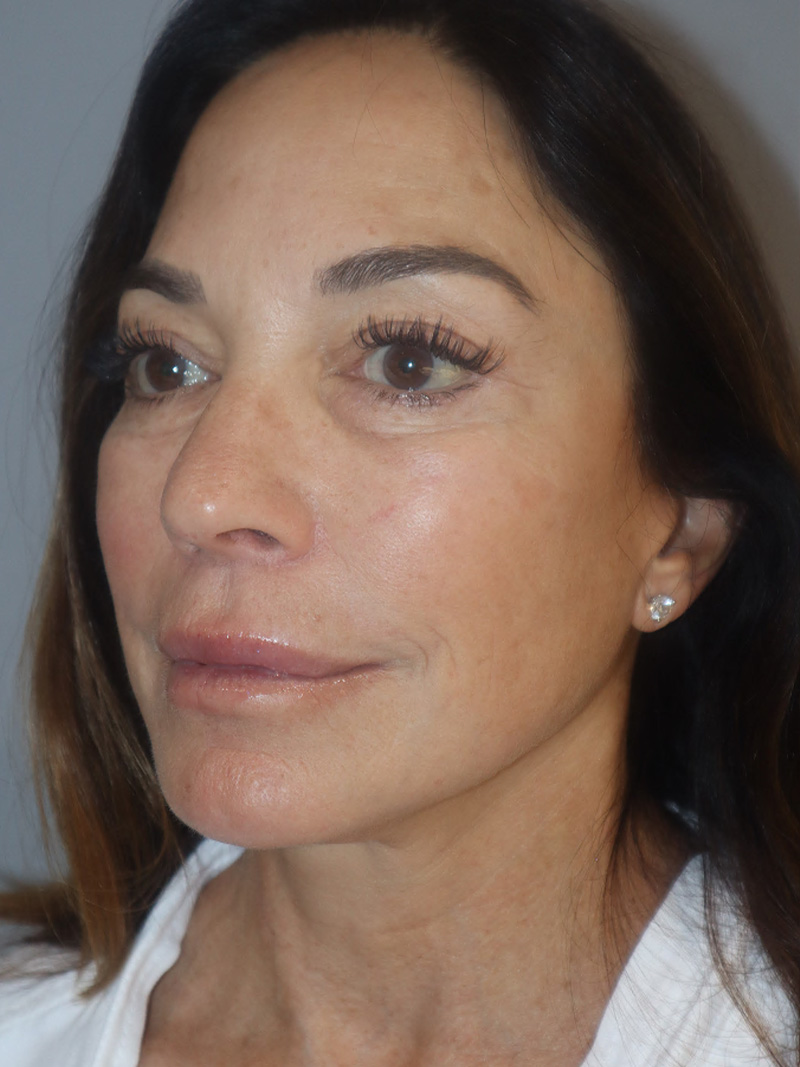 Facelift Before and After 48 | Grover Aesthetics