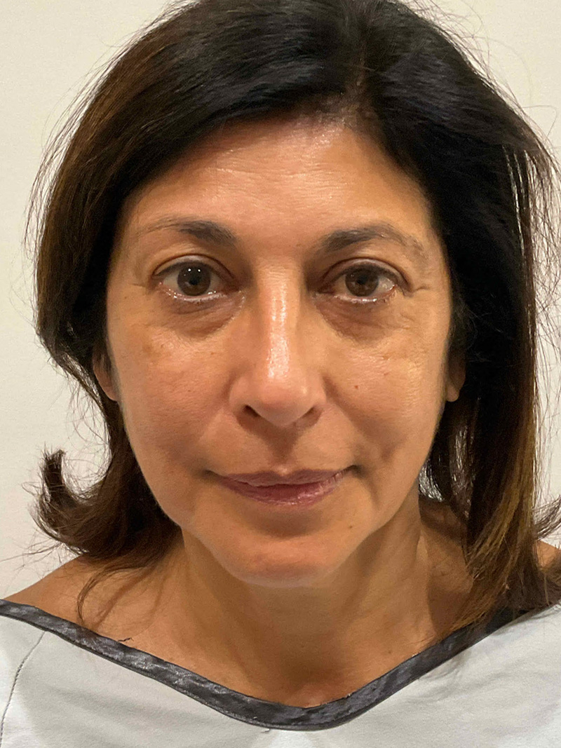Facelift Before and After 22 | Grover Aesthetics