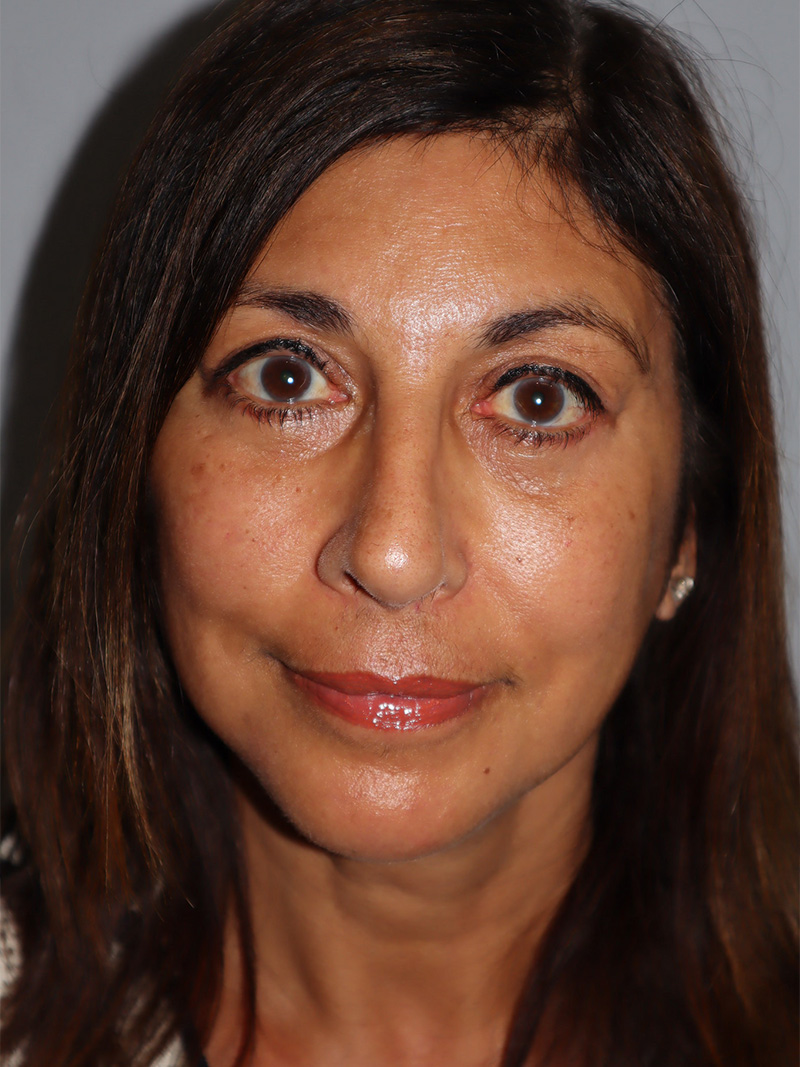 Facelift Before and After 49 | Grover Aesthetics