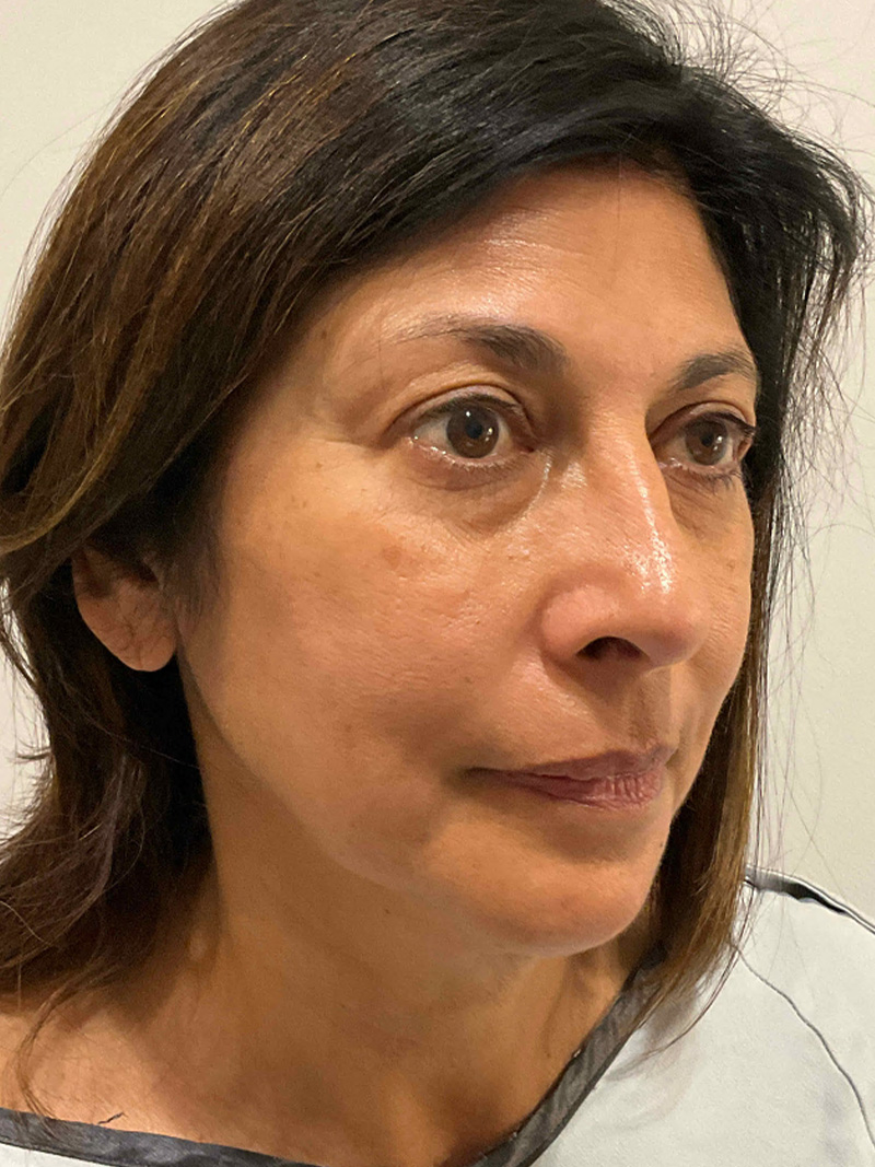 Facelift Before and After 49 | Grover Aesthetics