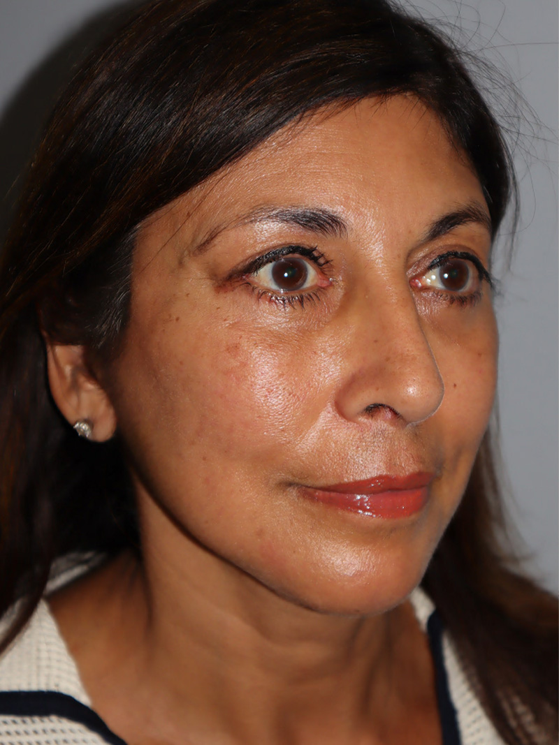 Facelift Before and After 49 | Grover Aesthetics