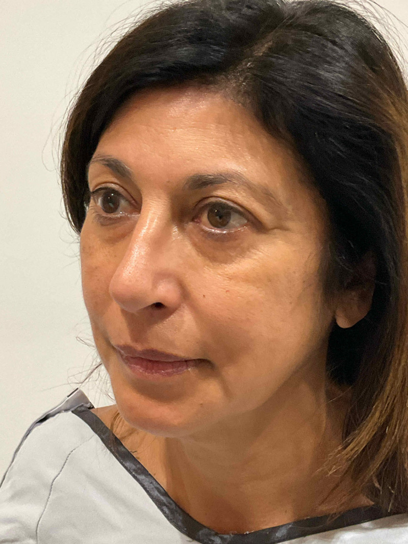Facelift Before and After 49 | Grover Aesthetics