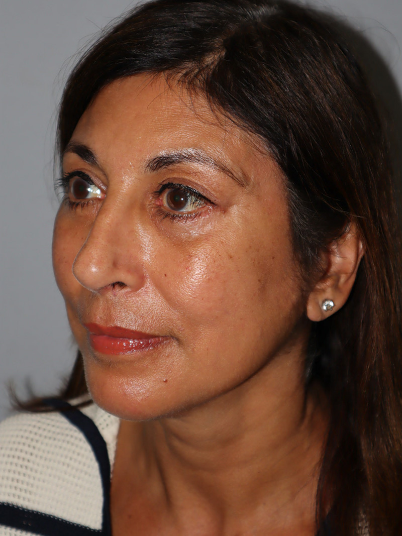 Facelift Before and After 49 | Grover Aesthetics