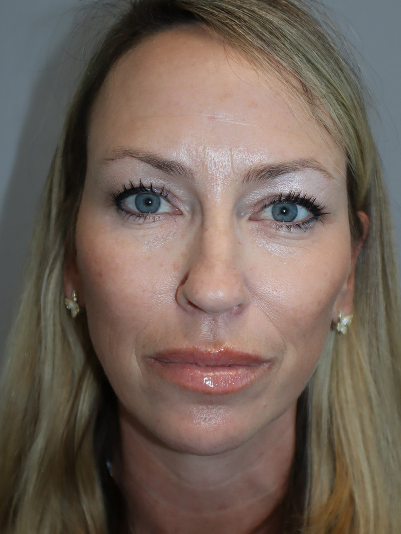 Facelift Before and After 22 | Grover Aesthetics