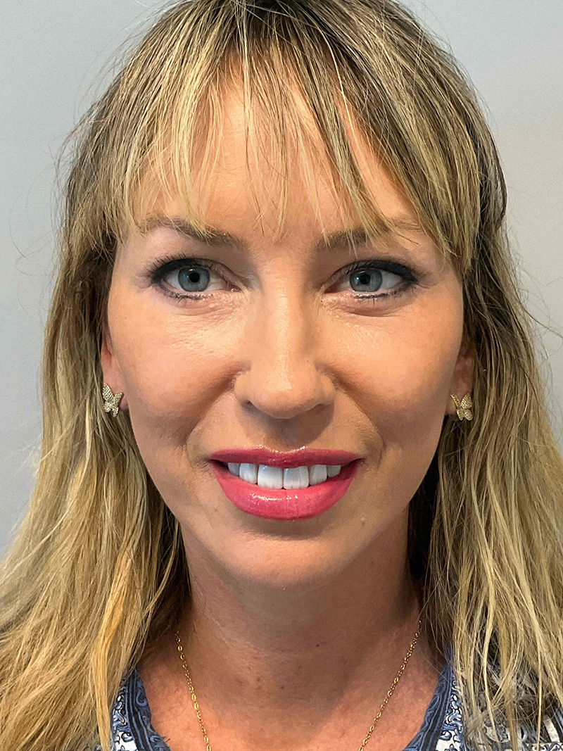 Facelift Before and After 50 | Grover Aesthetics