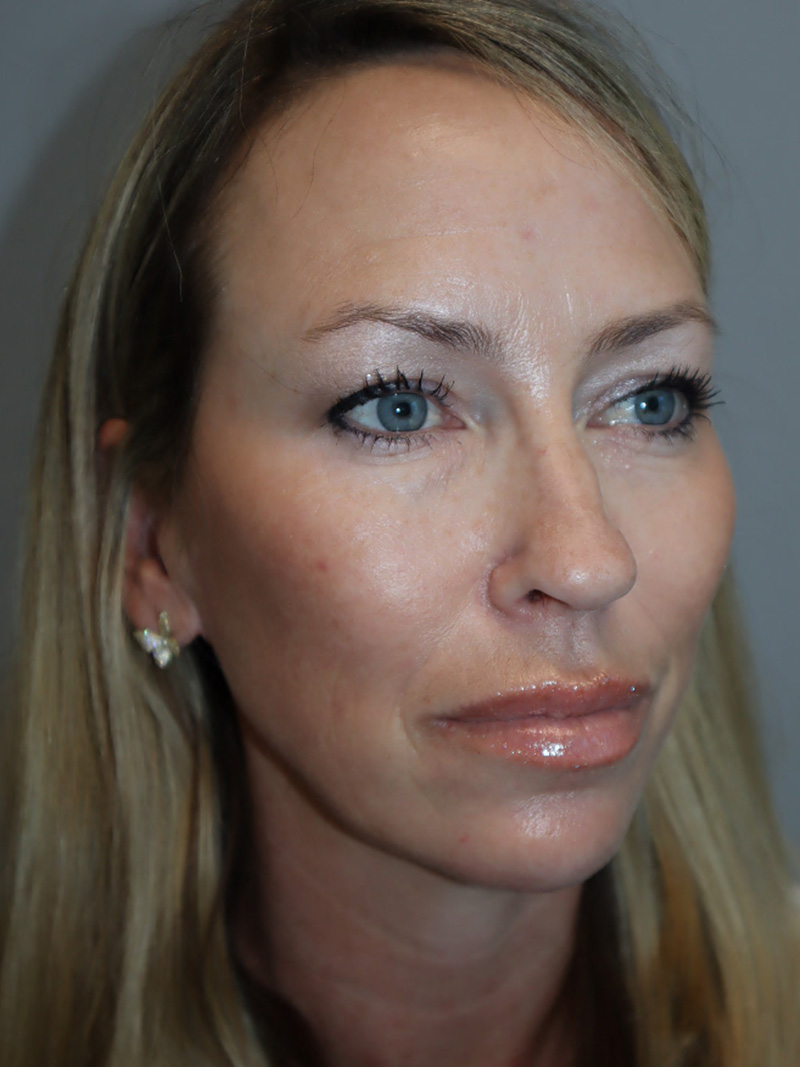 Facelift Before and After 50 | Grover Aesthetics