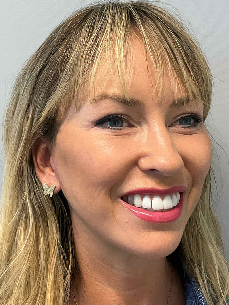 Facelift Before and After 50 | Grover Aesthetics