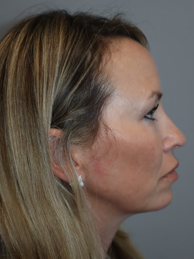 Facelift Before and After 50 | Grover Aesthetics