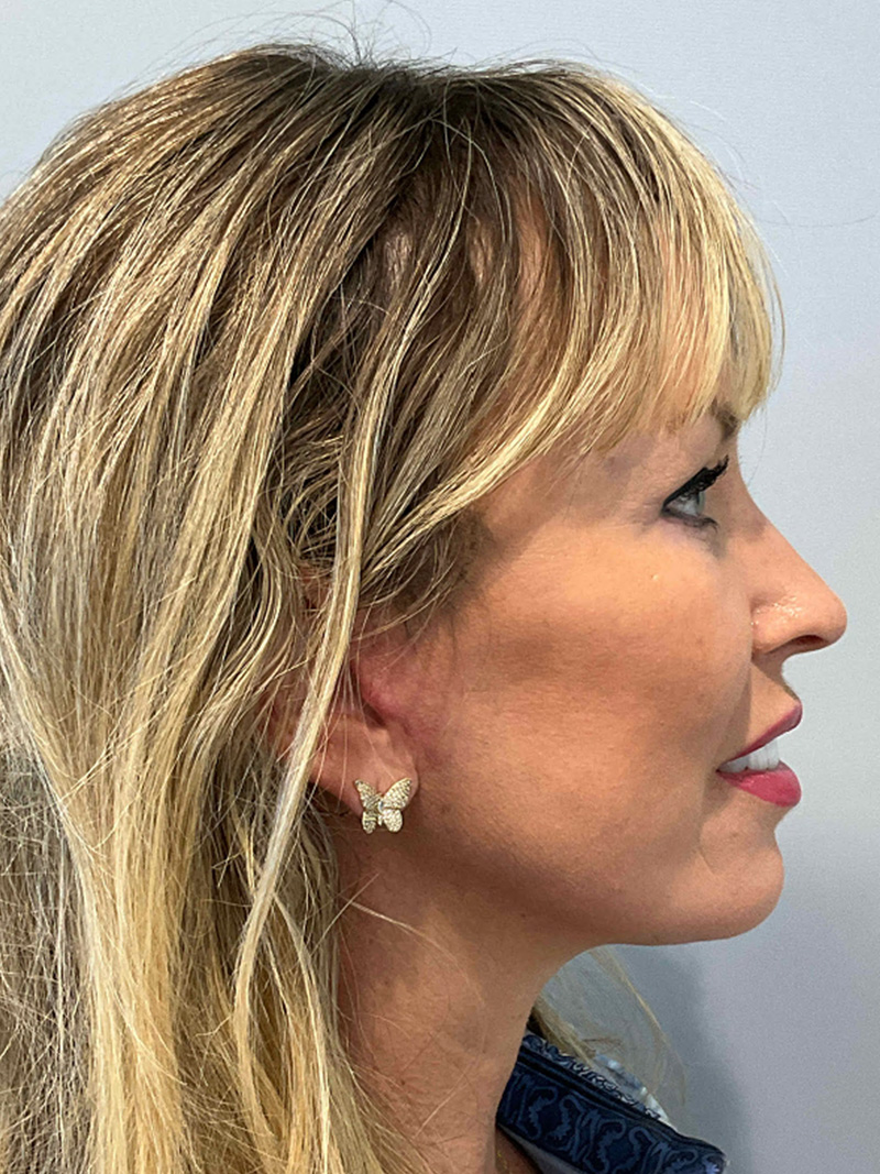 Facelift Before and After 50 | Grover Aesthetics