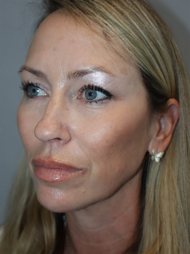 Facelift Before and After 50 | Grover Aesthetics