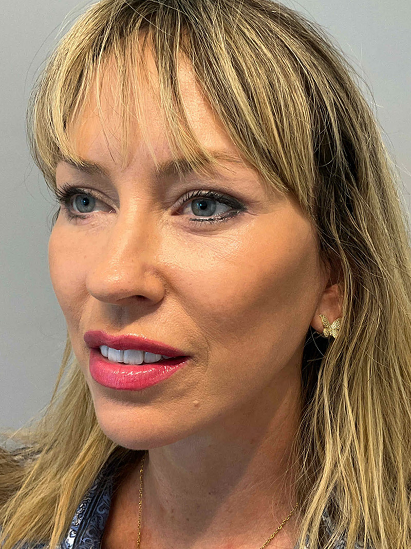 Facelift Before and After 50 | Grover Aesthetics