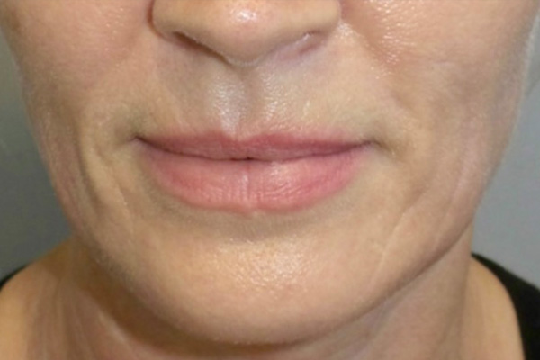 Lip Lift Before and After 01 | Sanjay Grover MD FACS