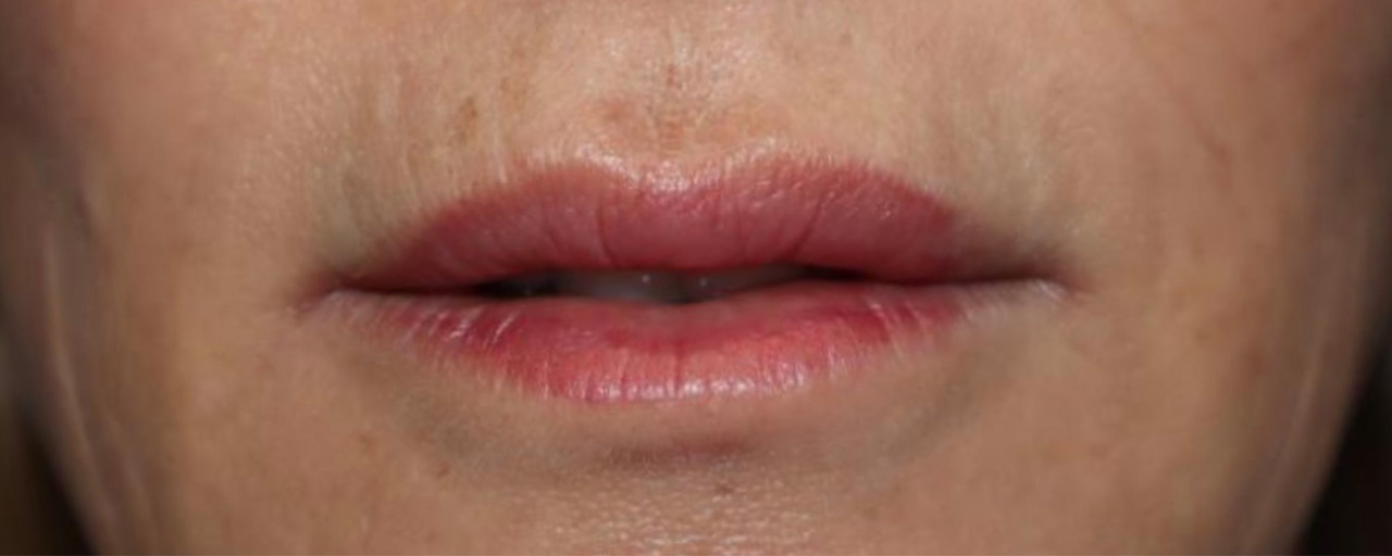Lip Lift Before and After | Grover Aesthetics