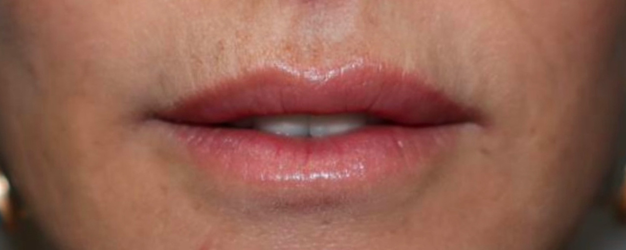 Lip Lift Before and After 01 | Sanjay Grover MD FACS