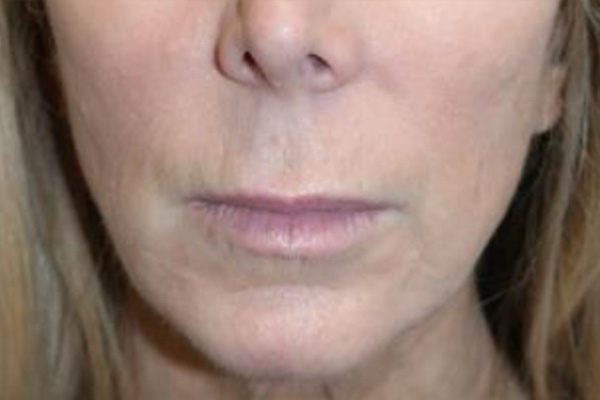 Lip Lift Before and After | Grover Aesthetics