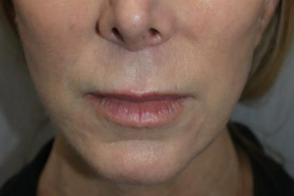 Lip Lift Before and After | Grover Aesthetics