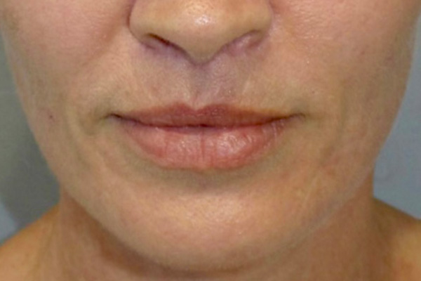 Lip Lift Before and After | Grover Aesthetics