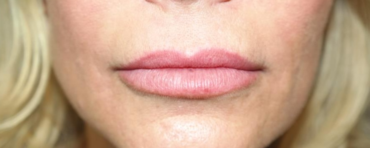 Lip Lift Before and After 02 | Sanjay Grover MD FACS