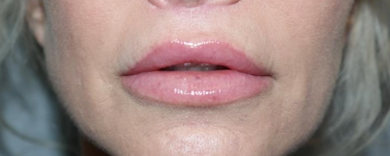 Lip Lift Before and After | Grover Aesthetics