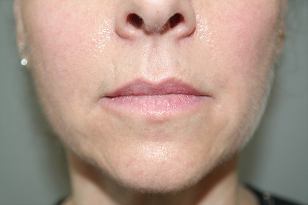 Lip Lift Before and After | Grover Aesthetics