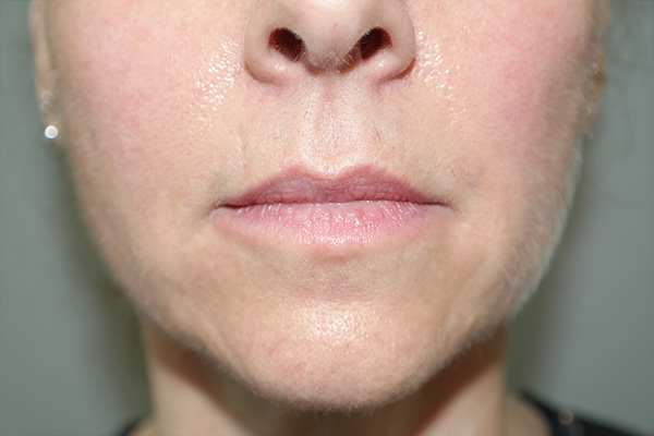 Lip Lift Before and After 03 | Sanjay Grover MD FACS