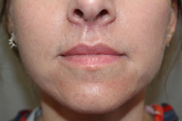 Lip Lift Before and After | Grover Aesthetics