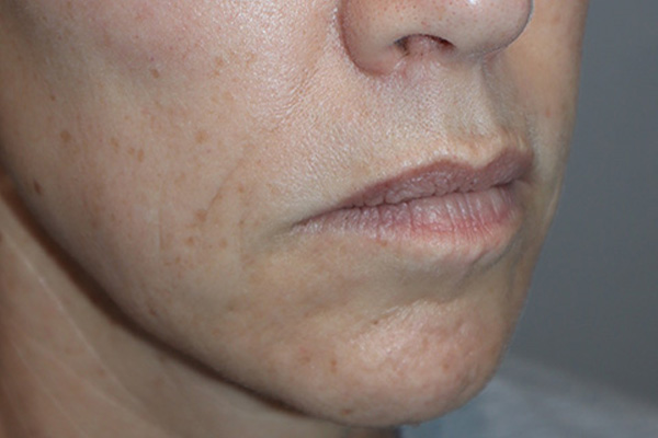 Lip Lift Before and After 05 | Grover Aesthetics