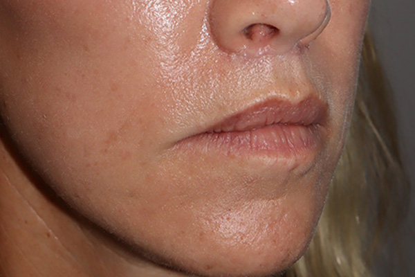 Lip Lift Before and After 05 | Grover Aesthetics