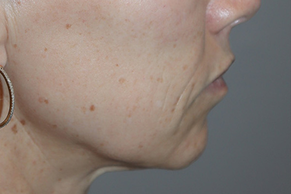 Lip Lift Before and After 05 | Grover Aesthetics