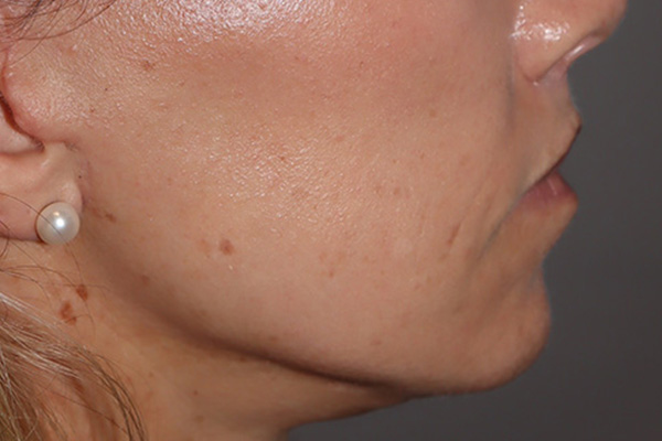 Lip Lift Before and After 05 | Grover Aesthetics