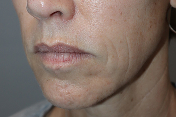 Lip Lift Before and After 05 | Grover Aesthetics