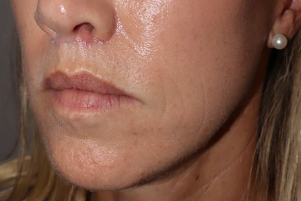 Lip Lift Before and After 05 | Grover Aesthetics