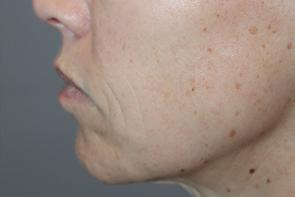 Lip Lift Before and After 05 | Grover Aesthetics