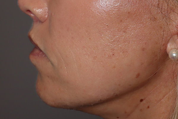 Lip Lift Before and After 05 | Grover Aesthetics