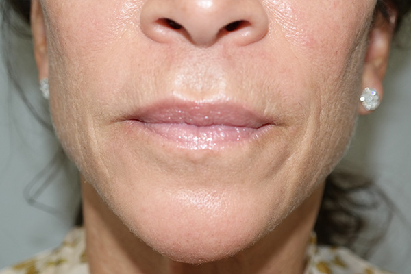 Lip Lift Before and After | Grover Aesthetics