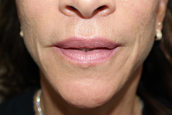 Lip Lift Before and After | Grover Aesthetics