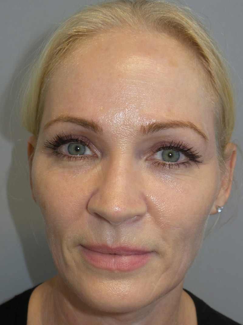 Lip Lift Before and After | Grover Aesthetics