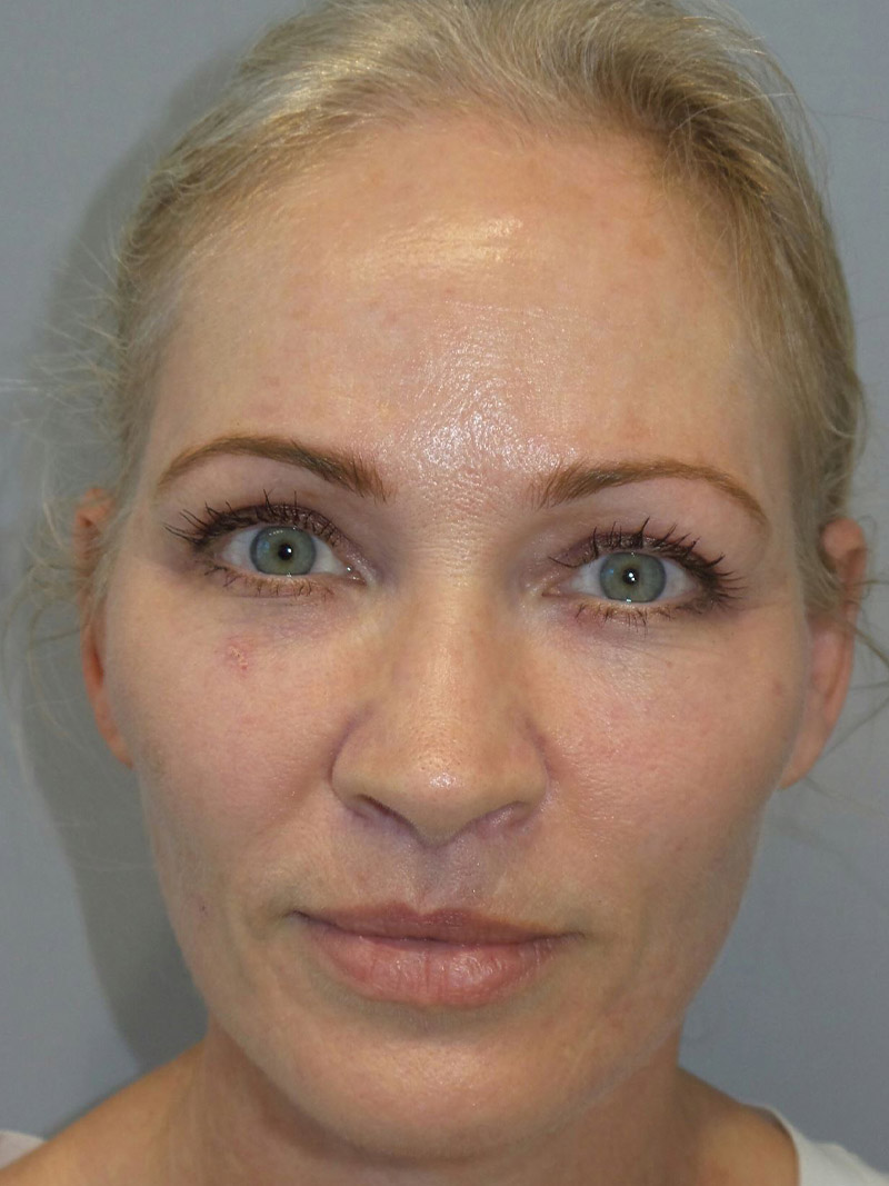 Lip Lift Before and After | Grover Aesthetics