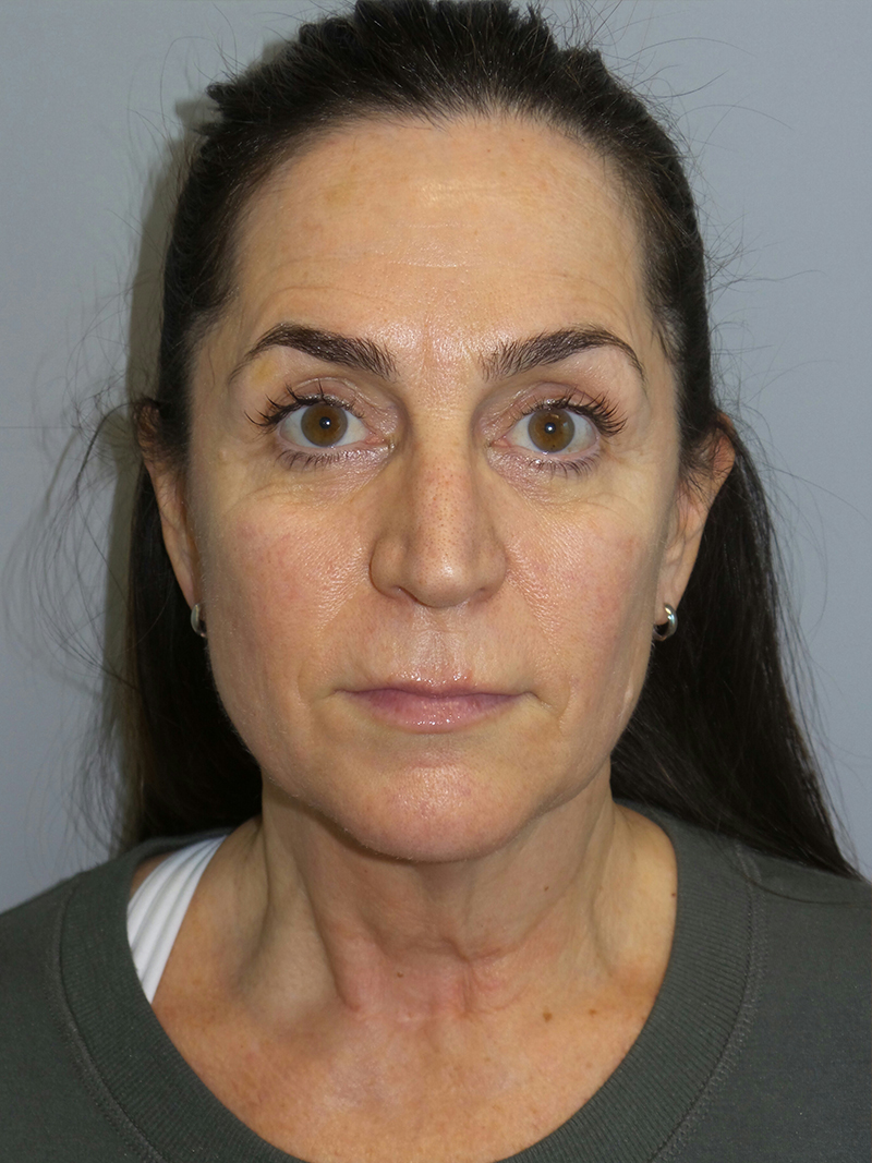 Lip Lift Before and After | Grover Aesthetics