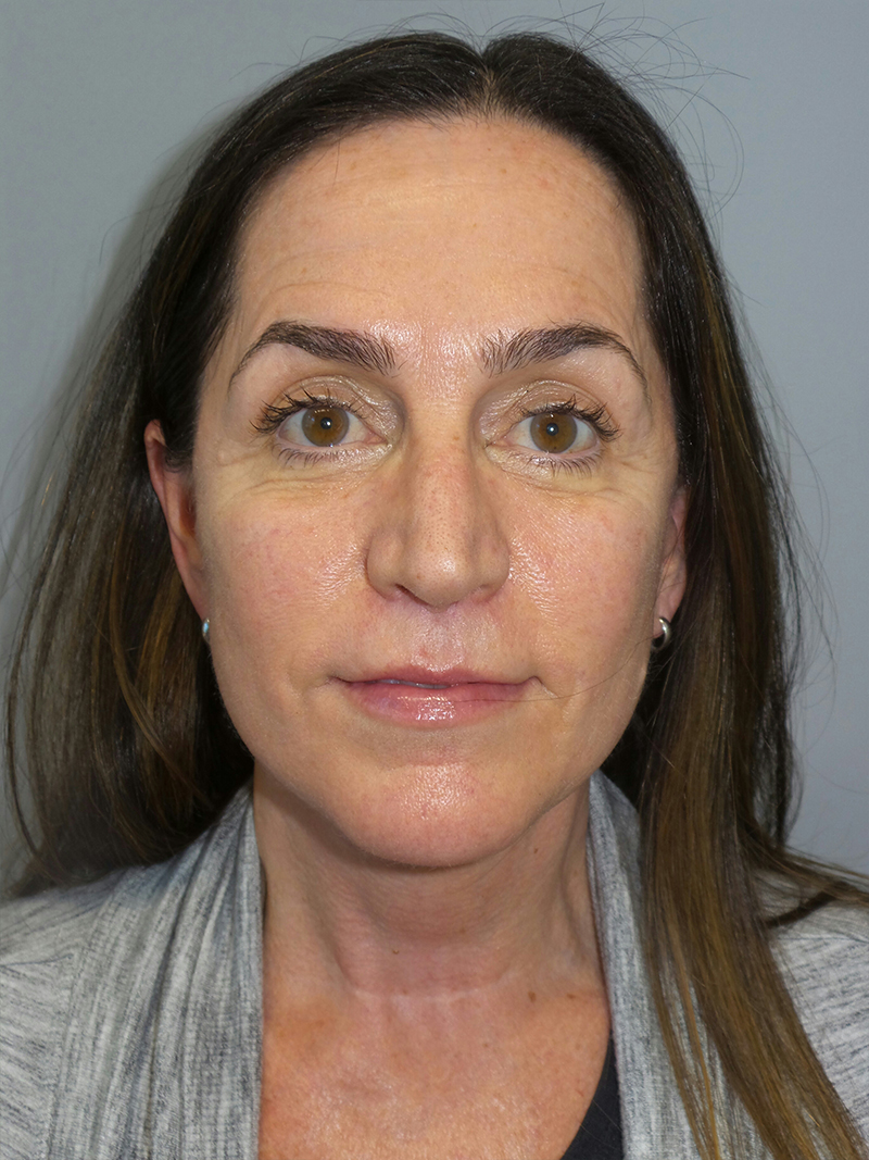 Lip Lift Before and After | Grover Aesthetics