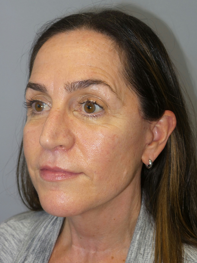 Lip Lift Before and After 08 | Grover Aesthetics
