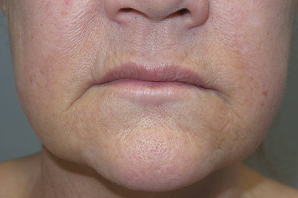 Lip Lift Before and After | Grover Aesthetics